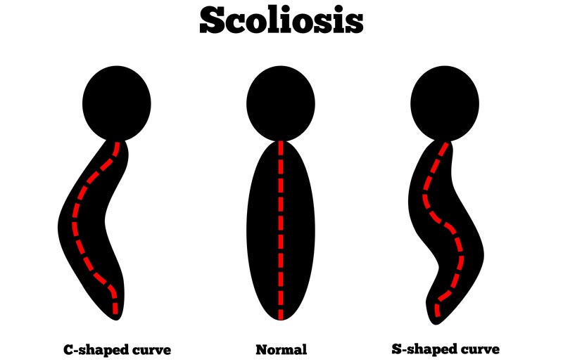 Las Vegas, NV scoliosis treatment